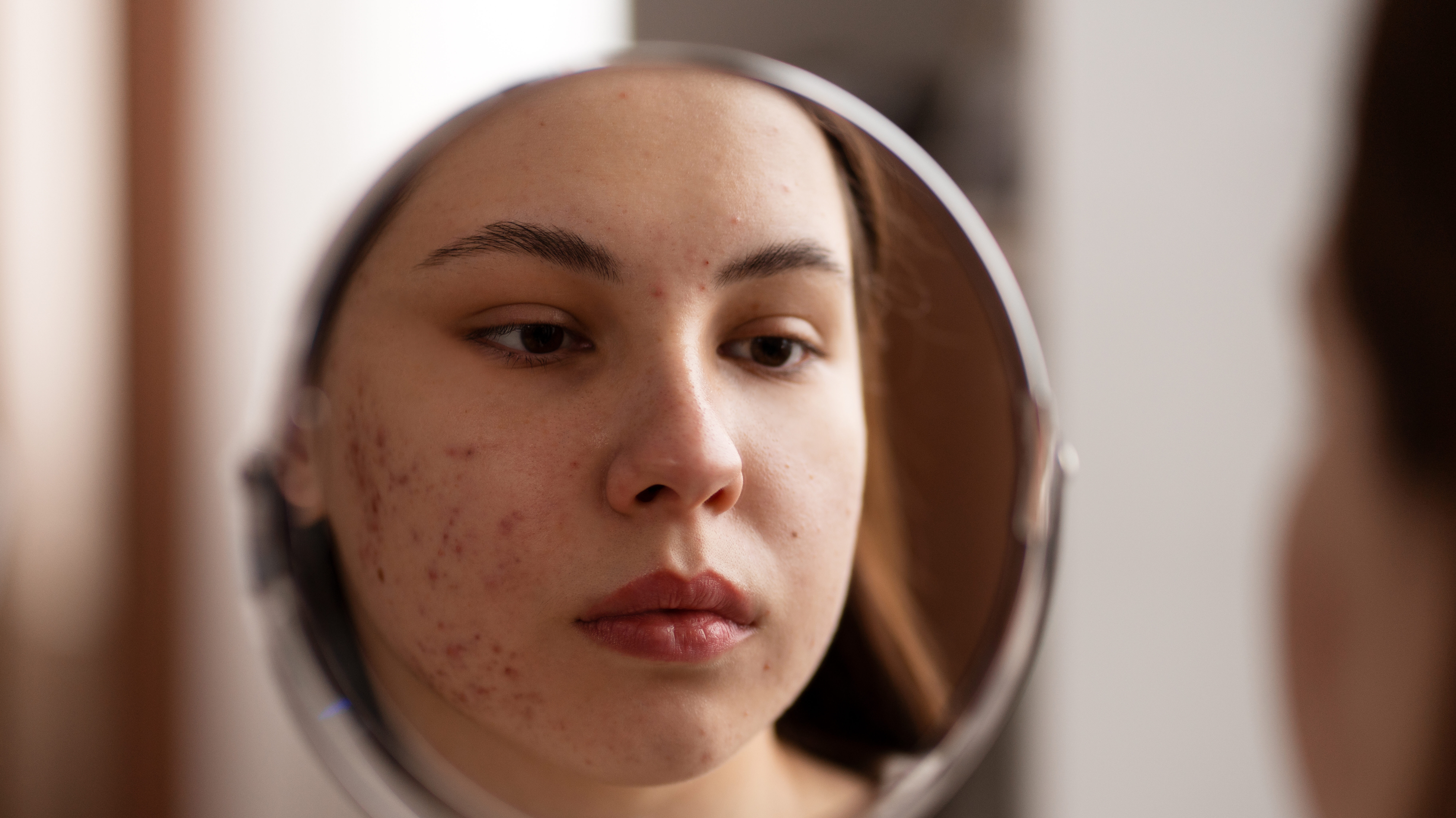 Lady worried about acne scars